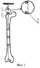Способ дистального блокирования канюлированных стержней при интрамедуллярном остеосинтезе длинных трубчатых костей (патент 2252723)