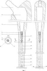 Комплект для эндопротезирования тазобедренного сустава (патент 2591534)