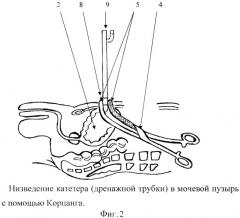 Антеградный способ надлобковой эпицистостомии при внутрибрюшных разрывах мочевого пузыря (патент 2454950)