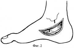 Способ хирургического лечения молоткообразной деформации ii-iv пальцев (патент 2285476)