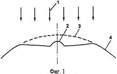 Способ хирургической коррекции пресбиопии в сочетании со сложным миопическим астигматизмом (патент 2314080)