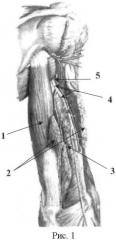 Способ восстановления активного сгибания в локтевом суставе у больных с артрогрипозом (патент 2434596)