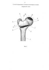 Способ оперативного лечения остеонекроза головки бедренной кости (патент 2578833)