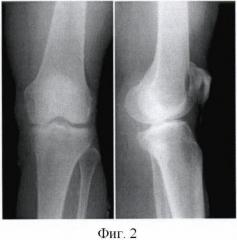 Способ лечения ранних стадий остеоартроза коленного сустава (патент 2367447)