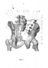 Способ реконструкции костей таза (патент 2625986)