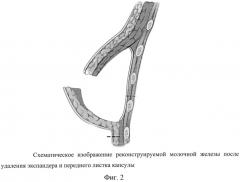 Способ формирования инфрамаммарной складки при двухэтапной реконструкции молочной железы (патент 2567790)