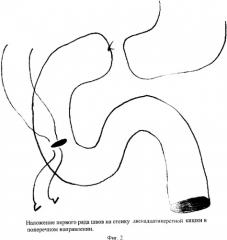 Способ хирургического лечения наружного свища двенадцатиперстной кишки (патент 2352268)