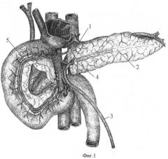 Способ хирургического лечения хронического панкреатита (патент 2421158)