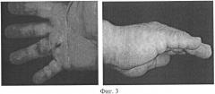 Способ безоперационного лечения контрактуры дюпюитрена iii-iv степени тяжести (патент 2540919)
