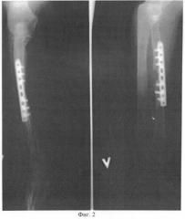 Способ лечения перелома или последствий травм диафиза кости(ей) предплечья (патент 2493791)