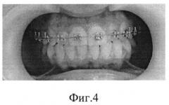 Способ трансверзального расширения верхнего зубного ряда (патент 2559762)