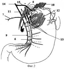 Способ селективной желудочной ваготомии (патент 2269946)