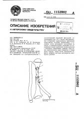 Способ устранения дефекта диафиза трубчатой кости (патент 1153902)