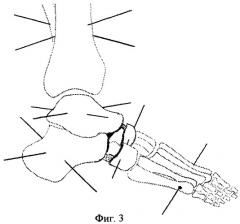 Способ оперативной коррекции деформаций стопы (патент 2412661)