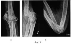 Способ восстановления функции локтевого сустава при псевдоартрозе мыщелка плечевой кости (патент 2521536)