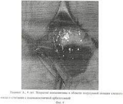 Способ хирургического лечения субпериостального абсцесса внутренней стенки орбиты (патент 2458660)