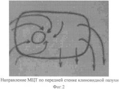 Способ проведения оперативного лечения заболеваний клиновидной пазухи (патент 2350288)