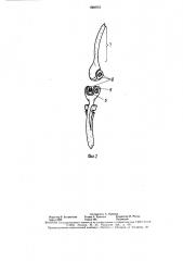 Эндопротез локтевого сустава (патент 1600757)