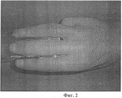 Способ кожной пластики при множественных повреждениях ладонной поверхности пальцев кисти (патент 2448656)