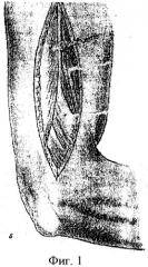 Способ восстановления дефекта лучевого нерва повреждения на уровне плеча (патент 2543623)