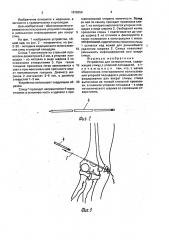 Устройство для остеосинтеза (патент 1678350)