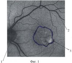 Способ прогнозирования течения возрастной макулярной дегенерации (патент 2386387)