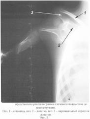 Способ реконструкции надплечья при его деформации (патент 2332182)