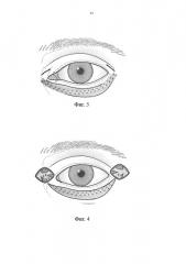 Способ устранения паралитического лагофтальма (патент 2635082)