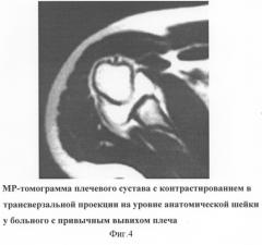 Способ диагностики нестабильности плечевого сустава (патент 2277852)