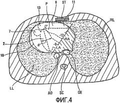 Цельный сердечный протез, имплантируемый в анатомической позиции (патент 2409394)