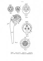 Искусственный тазобедренный сустав (патент 772546)