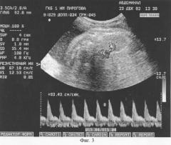 Способ оценки состояния плода и прогнозирования состояния новорожденного при сахарном диабете матери по показателям кровотока при допплерометрическом исследовании (патент 2251976)