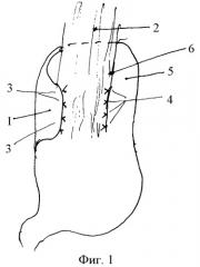 Способ хирургического лечения рефлюкс-эзофагита (патент 2441601)