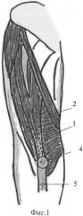 Способ аутопластики переднего отдела коленного сустава после эндопротезирования (патент 2393800)