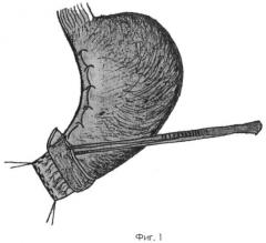 Способ формирования инвагинационного арефлюксного гастродуоденоанастомоза (патент 2364351)