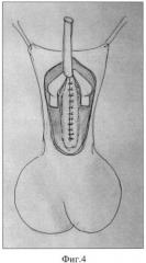 Способ хирургического лечения дистальной гипоспадии у мальчиков (патент 2428124)
