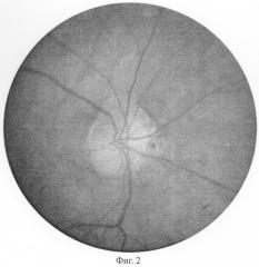 Способ прогнозирования эффективности лечения при частичной атрофии зрительного нерва (патент 2282391)