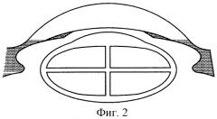 Способ экстракции плотных катаракт (патент 2281742)