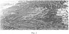 Способ дифференциальной диагностики простой и быстрорастущей миомы матки с нормальным строением эндометрия (патент 2554824)