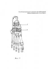 Способ функционального артродеза при диабетической нейроостеоартропатии (стопа шарко) (патент 2604383)