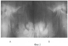 Способ рентгенодиагностики различных типов дисплазии височно-нижнечелюстного сустава (патент 2462993)