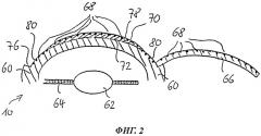 Способ лазерного интрастромального кератомилеза (патент 2505273)
