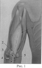 Способ транспозиции длинной головки трехглавой мышцы плеча в позицию двуглавой мышцы плеча у детей с артрогрипозом (патент 2503423)