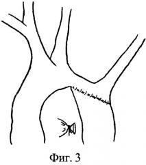 Способ хирургической коррекции коарктации аорты у детей раннего возраста (патент 2477082)