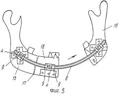 Компрессионно-дистракционный аппарат швыркова (патент 2264189)