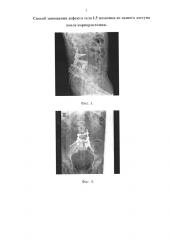 Способ замещения дефекта тела l5 позвонка из заднего оперативного доступа после корпорэктомии (патент 2594445)