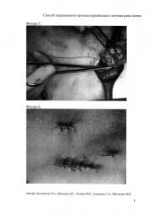 Способ оперативного органосохраняющего лечения рака почки (патент 2653910)