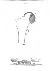 Протез головки бедра (патент 619179)