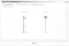 Способ трехмерной визуализации длинных трубчатых костей при диафизарных переломах (патент 2342077)