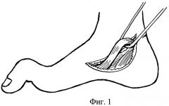 Способ хирургического лечения молоткообразной деформации первого пальца стопы (патент 2285477)